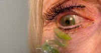 Doctor Finds 23 Stuck Contact Lenses in Patient's Eye After Years of Neglect